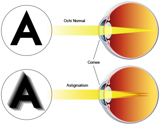 ASTIGMATISM_ro